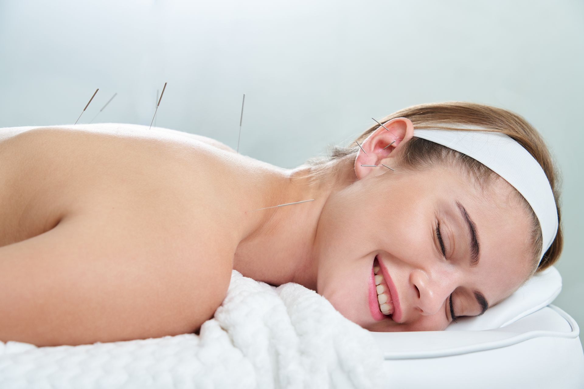 A woman is smiling while getting acupuncture on her back
