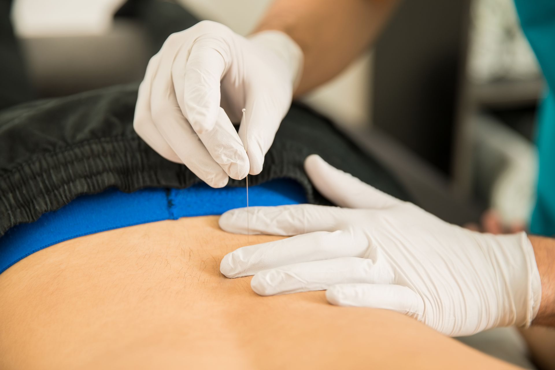 A woman is getting acupuncture on her back