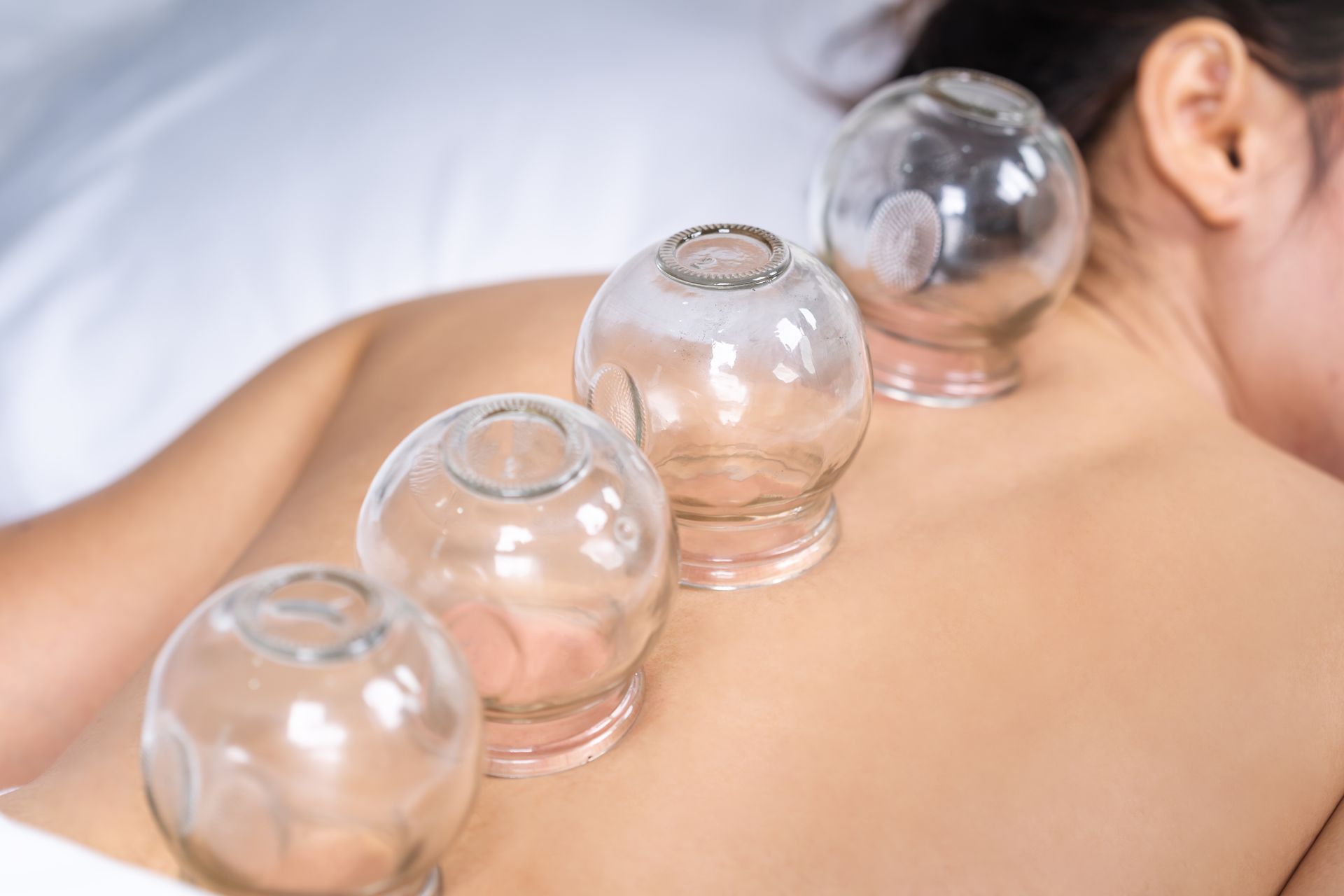 A woman is getting cupping treatment on her back
