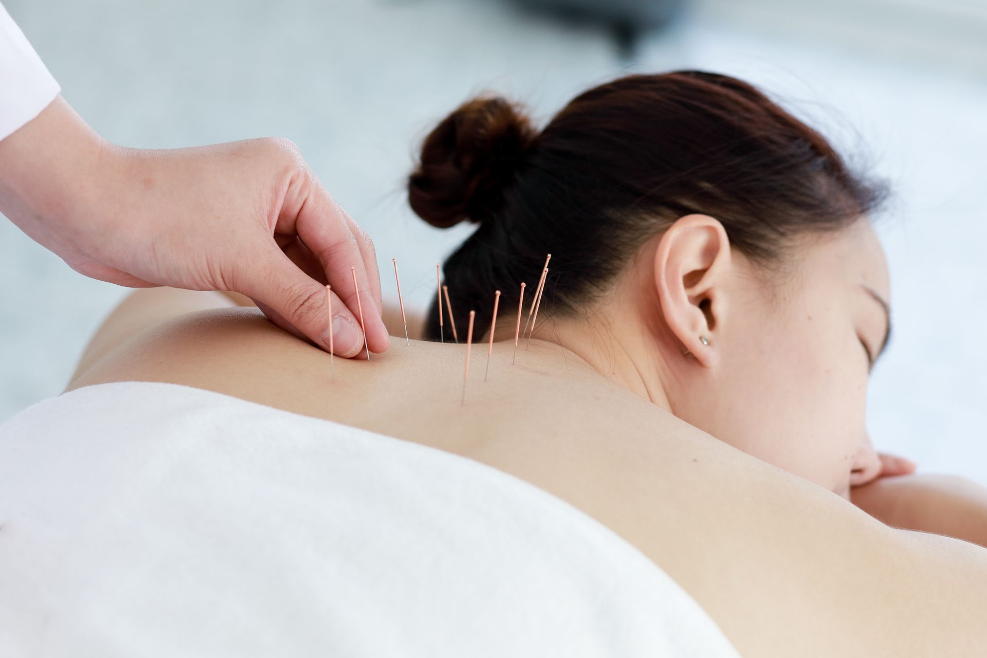 A woman is getting acupuncture on her back