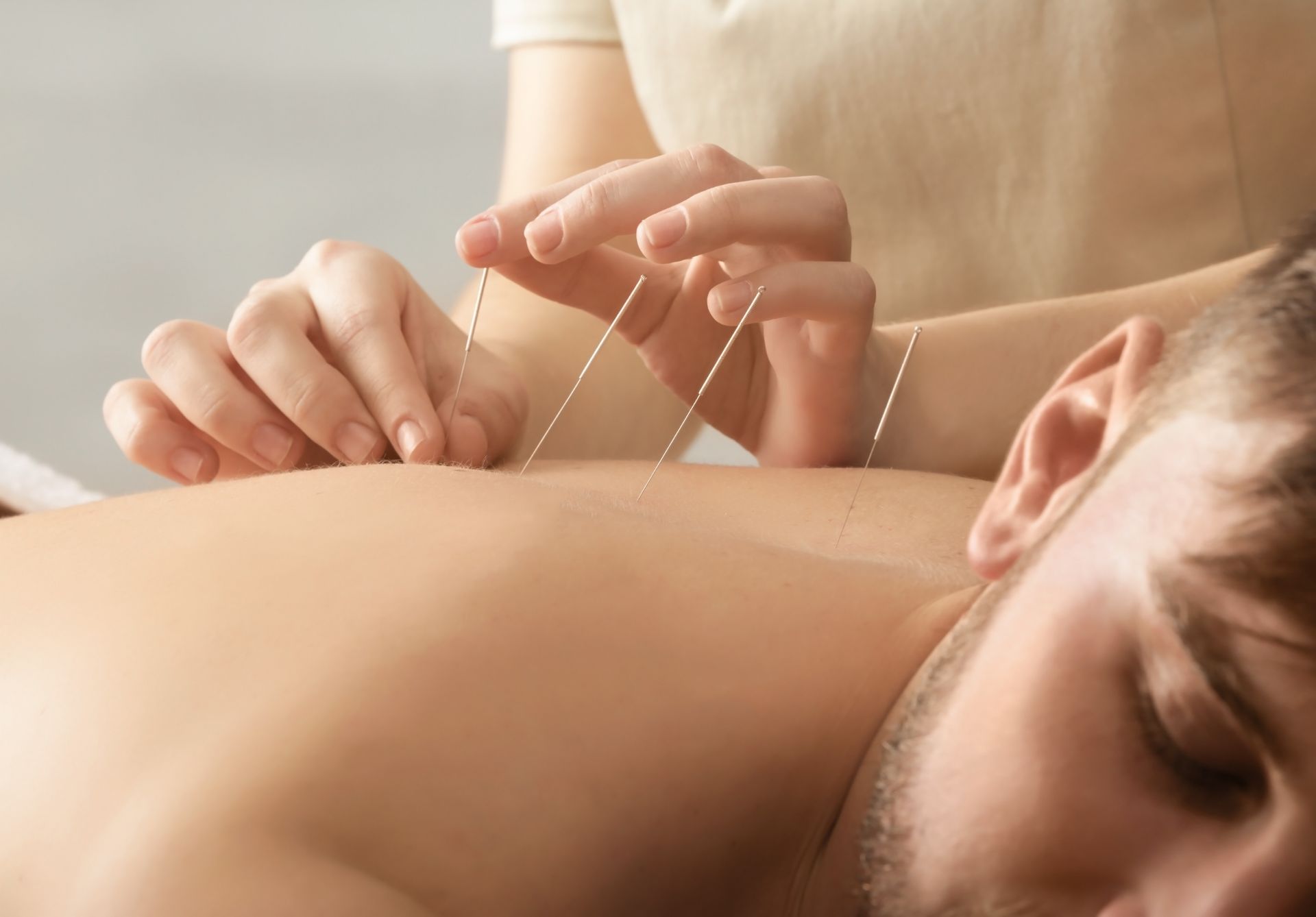A man is getting acupuncture on his back