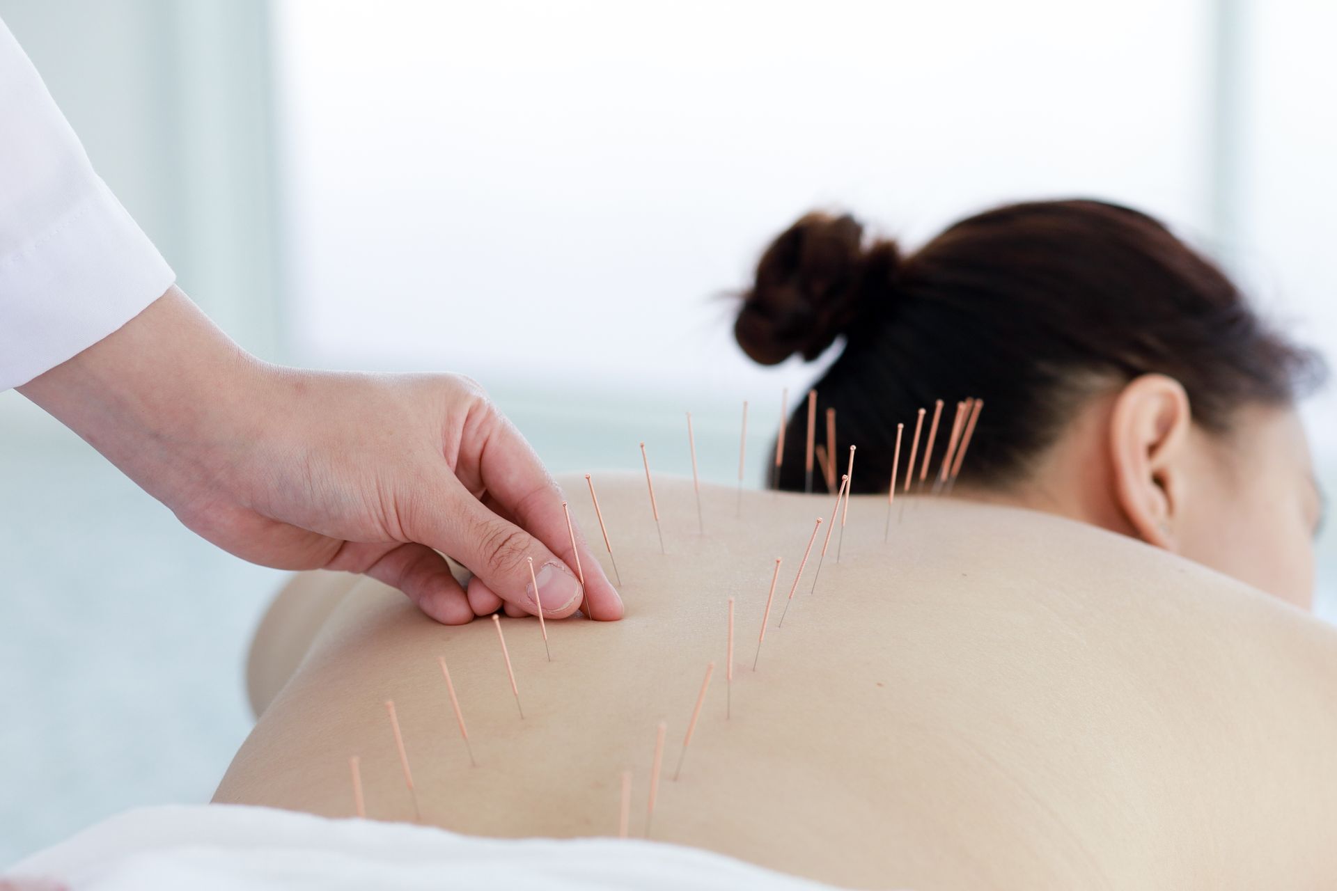 Woman undergoing acupuncture back treatment